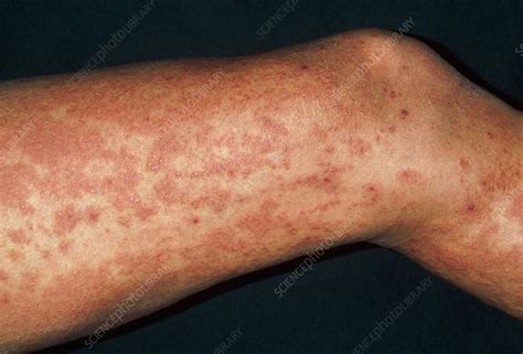 Urticaria Rash Hives On Legs Due To Exam Stress Stock Image M280