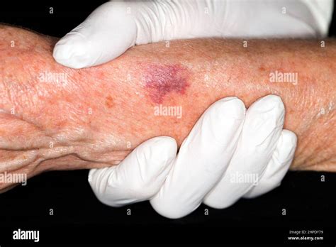 Nonthrombocytopenic Purpura Hi Res Stock Photography And Images Alamy