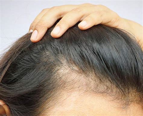 Expert Tips To Regrowing Hair On Bald Spot