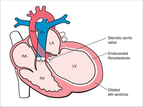 Hypoplastic Left Heart Syndrome And Critical Aortic Stenosis Obgyn Key