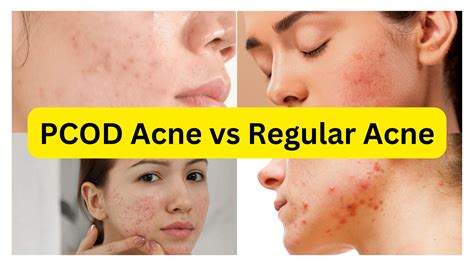 pcos pcod acne vs regular acne differences and 5 easy treatments