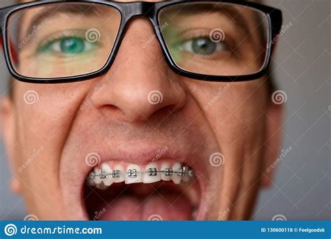 Curved Teeth Of Guy With Braces In Glasses Close Up Portrait Of Stock