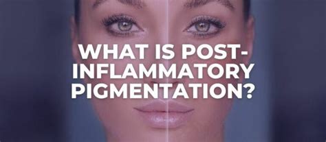 What Is Post Inflammatory Pigmentation Pih In Skincare