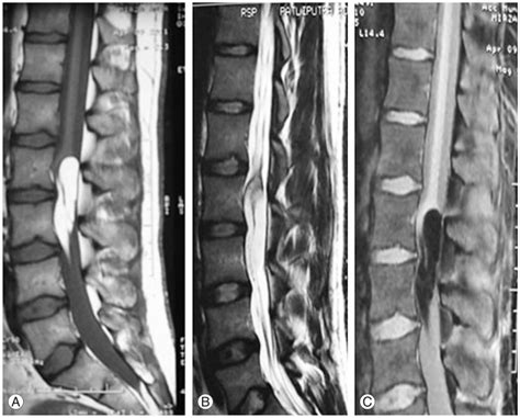 Sagittal T1 Weighted A T2 Weighted B And Fat Suppression C