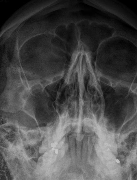 Nasal Bone Fracture Pediatric X Ray Nasal Bone Fracture Portal