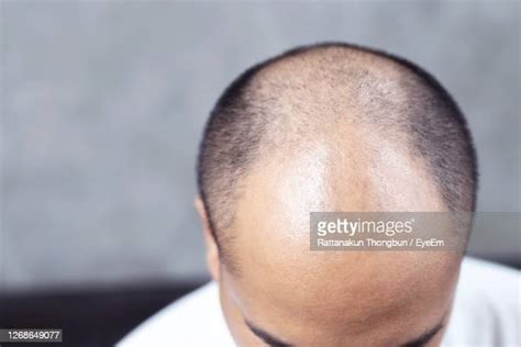 Man Balding Patch Photos And Premium High Res Pictures Getty Images