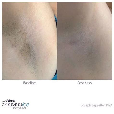 Soprano Ice Laser Hair Removal Hesperia And Redlands Locations