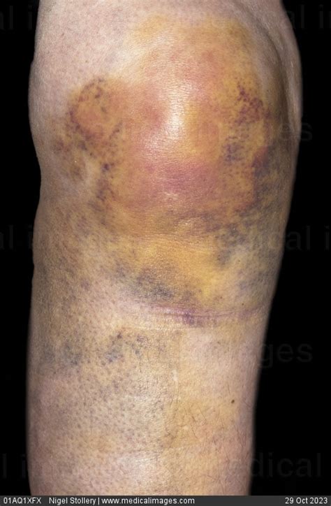 Stock Image Accidental Injury Extensive Knee Bruising Very Colorful
