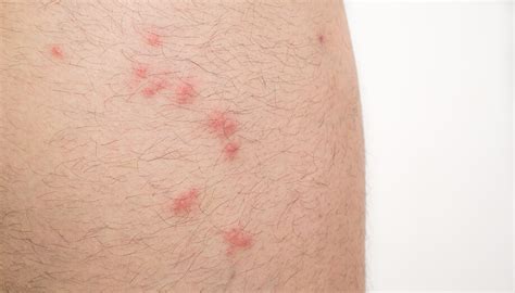 Identifying Common Insect Bites And Stings Sentinel Blog