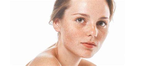Brown Spots On Neck Causes Signs Prevention And Treatments