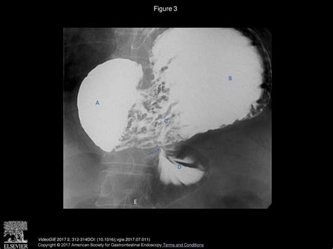 Endoscopic Diagnosis Of Paraesophageal Hernia With Gastric Volvulus