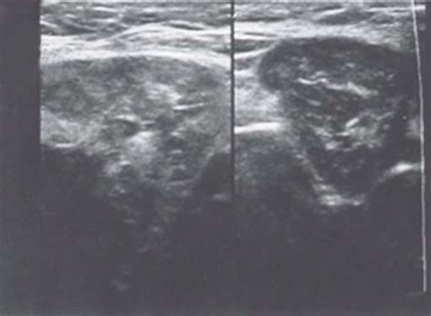 A Ultrasound Image Showing Bilateral Enlarged Submandibular Lymph