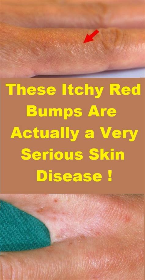 Red Itchy Bumps On Skin Causes Symptoms Pictures Trea Vrogue Co