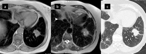 Screening For Lung Cancer Does Mri Have A Role European Journal Of