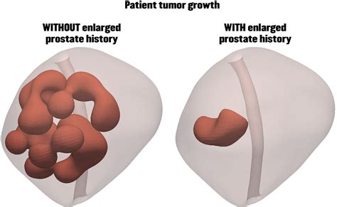 Enlarged Prostate Could Actually Be Stopping Tumor Growth Simulations Show