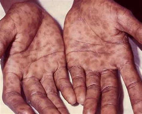 What Causes Fungal Infection On Hands And Feet