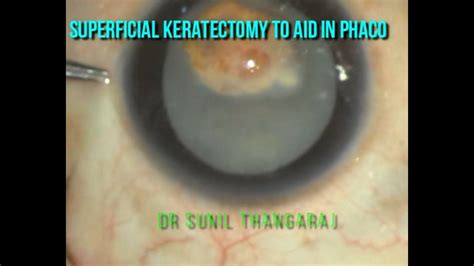 Superficial Keratectomy To Aid In A Case Of Nodular Dystrophy Hm