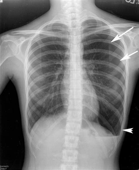 Figure 2 From Images In Cardiovascular Medicine A 21 Year Old College