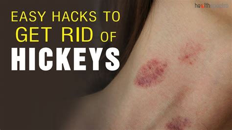 easy hacks to get rid of hickeys youtube