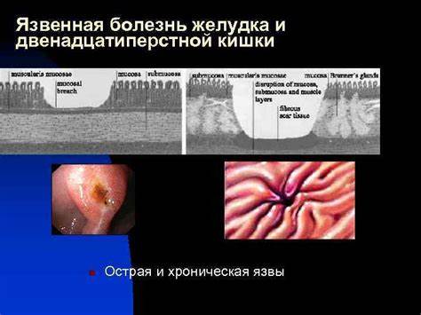Острая язва двенадцатиперстной кишки диета Острая язва двенадцатиперстной кишки диета