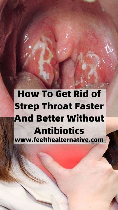 √ Signs Of Strep Throat