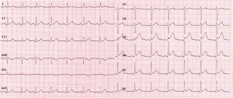 Dr Smith S Ecg Blog Terminal Qrs Distortion Diagnostic Of Lad