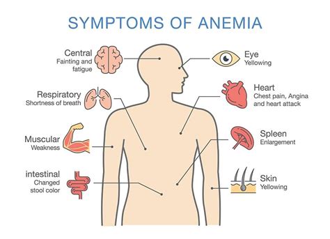 Anemia Symptoms What Are The Symptoms Of Anemia Healthella