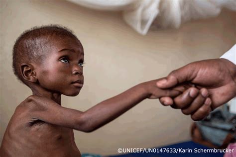 南スーダン。幼い命を救った栄養治療食とは
