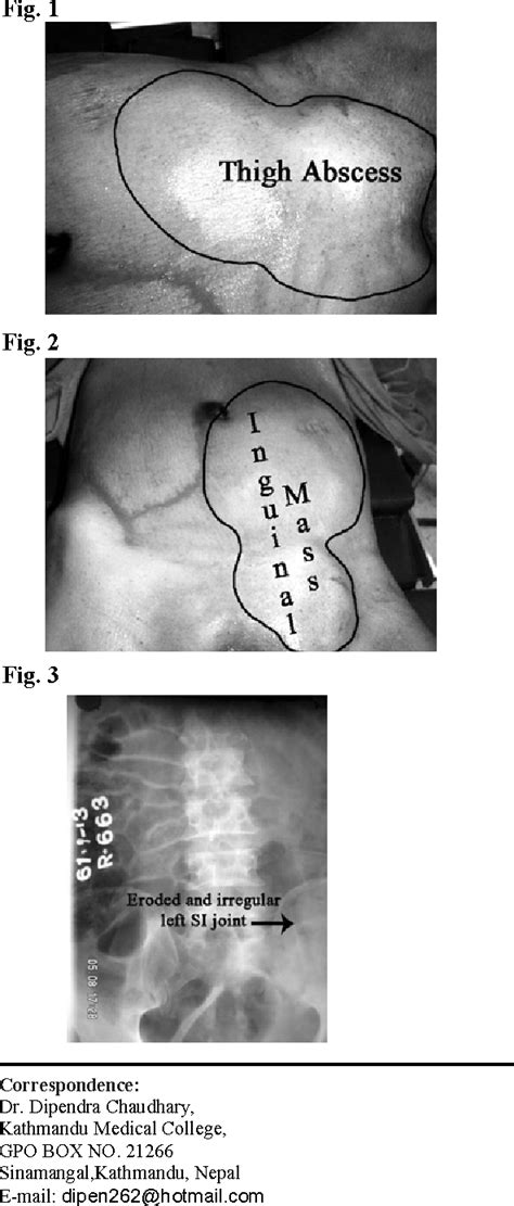 figure 3 from intra abdominal abscess presenting as a thigh abscess semantic scholar