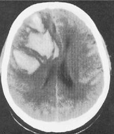 Figure 1 From Fatal Intracranial Hemorrhage In A Pregnant Patient With