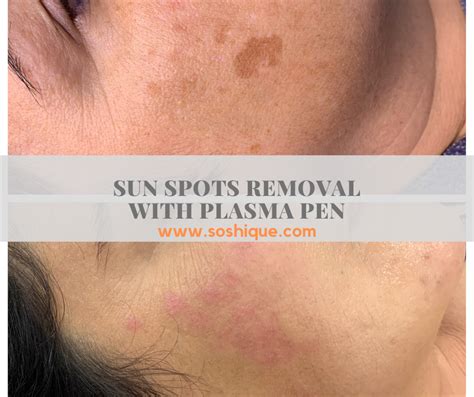 Skin Resurfacing With Plasma Pen For Removal Of Sunage Spots