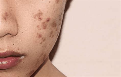 A Dermatologists Advice For The Best Way To Get Rid Of Dark Post Acne Spots The Frisky
