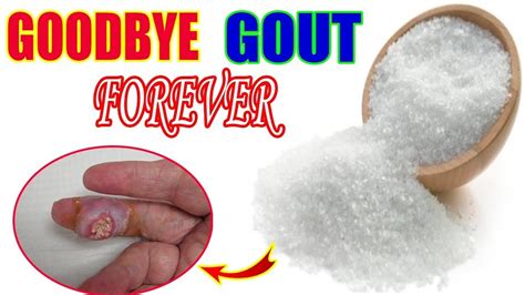 Does Epsom Salt Work For Gout
