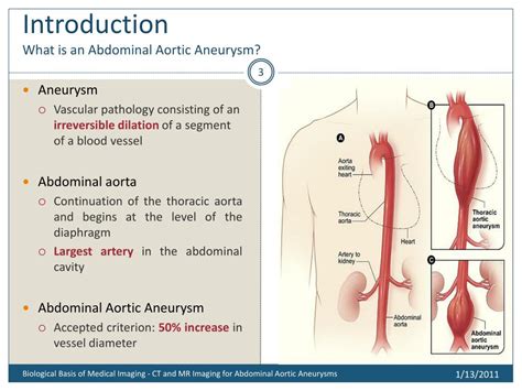 Ppt Ct And Mr Imaging Of Abdominal Aortic Aneurysm Powerpoint Images