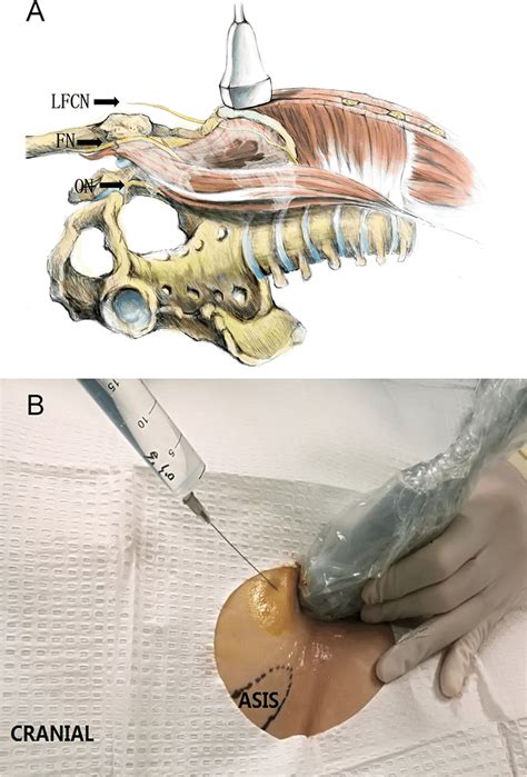 The Lateral Femoral Cutaneous Nerve Lfcn And Transducer Position