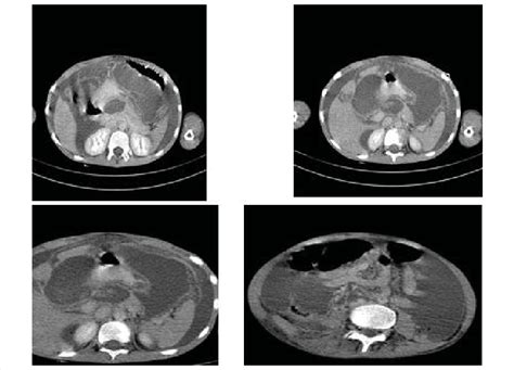 First Abdominopelvic Ct Scan With Iv And Oral Contrast At Admission