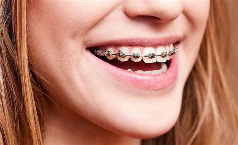 Simple Dental Procedures To Improve Your Smile Cards Dental