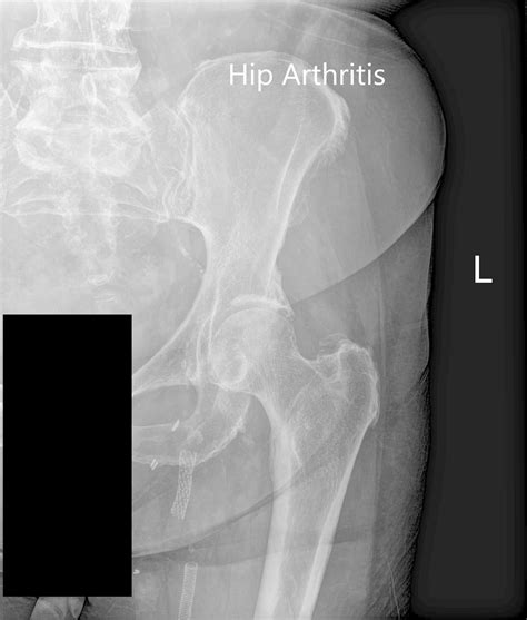 Case Study Left Hip Total Replacement In 82 Year Old Male