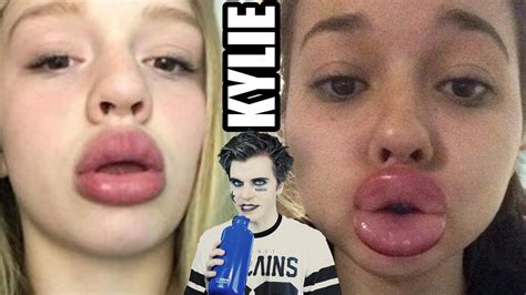 The Kylie Jenner Challenge Swollen Lips Challenge Uhohbro Youtube