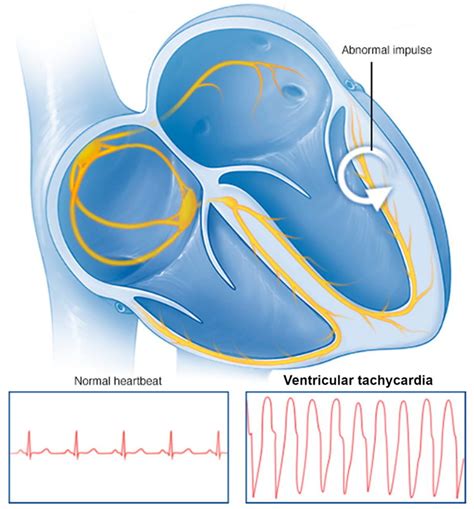 Tachycardia Causes Signs Symptoms Types Diagnosis And Treatment