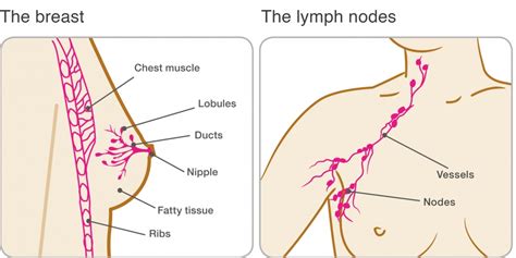 Lymph node involvement at the time of breast cancer diagnosis or surgery is the single most important anatomic predictor of risk of spread (metastasis) to other areas of the body. Primary breast cancer | Breast Cancer Now