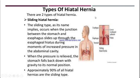 Hiatal Hernia Metro College Of Nursing Youtube