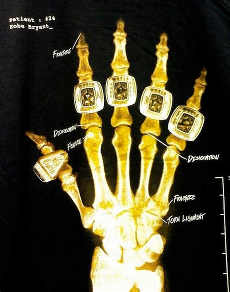 X Ray Of Kobes Right Hand Released Clutchfans