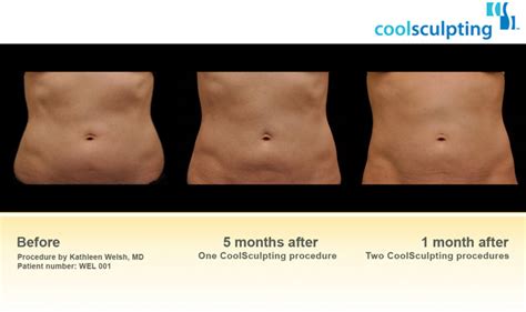 How Does Coolsculpting Workmarcus Medical Spa