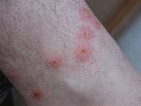 Is It Chiggers Or Poison Ivy Necps