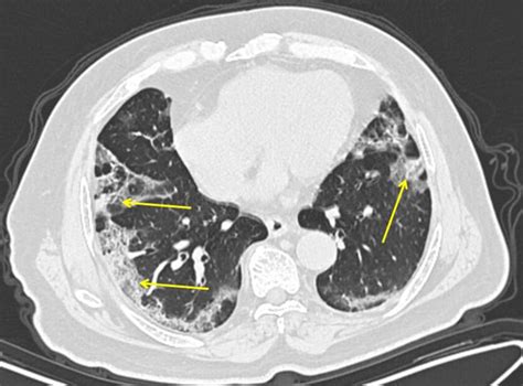 Covid 19 Lung Patterns Show Few Clues For Treating Pneumonia The San