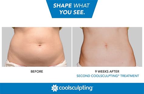 Coolsculpting Vs Liposuction Whats The Difference Blog