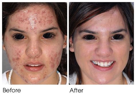 Dermasphere Acne 101 — Take Your First Step Towards Unblemished Beauty