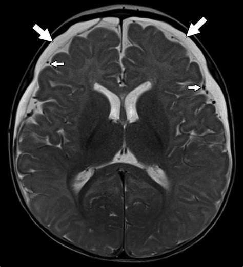 The Child With Macrocephaly Differential Diagnosis And Neuroimaging