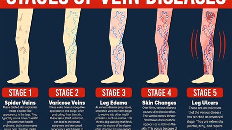 Treatment For Veins On Legs Treat Choices